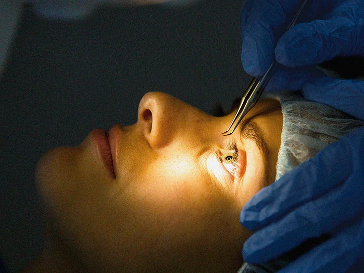 Brief description of Lasik laser eye surgery procedures